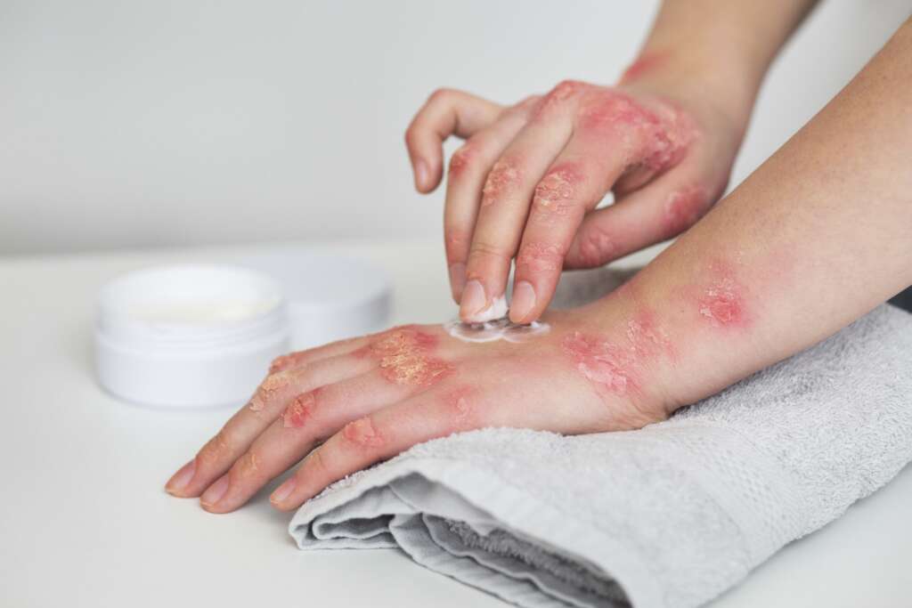 hands-patient-suffering-from-psoriasis